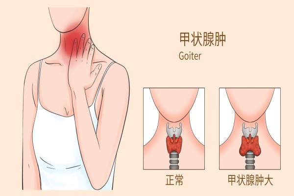 甲状腺癌术后2年会复发吗？什么保险可以预防甲状腺癌复发和转移